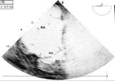 apoptotik indeks ortalamalar arasnda istatistiksel olarak anlaml düzeyde fark olduu bulundu (endokard, miyokard, epikard 5, p 000) Yaplan post hoc analizde, farklln miyokardiyal dokudan alnan