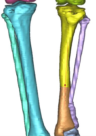 Özkan A., Mutlu İ., Çelik T., Kişioğlu Y., Ayan S. olacak şekilde uzuv sagittal düzlemde döndürülür ve normal anatomik eksen ile çakıştırılır (Şekil 3).