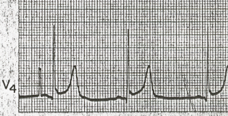 LABORATUVAR (ACEP-1995) - EKG: Sol superior QRS ekseni; Ventriküler hipertrofi; Sol atriyal dilatasyon; ST