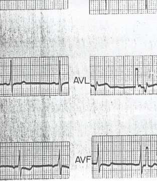 MYOKARDĐTTE EKG: Myokarditten şüphelenildiğinde, EKG de ST segment
