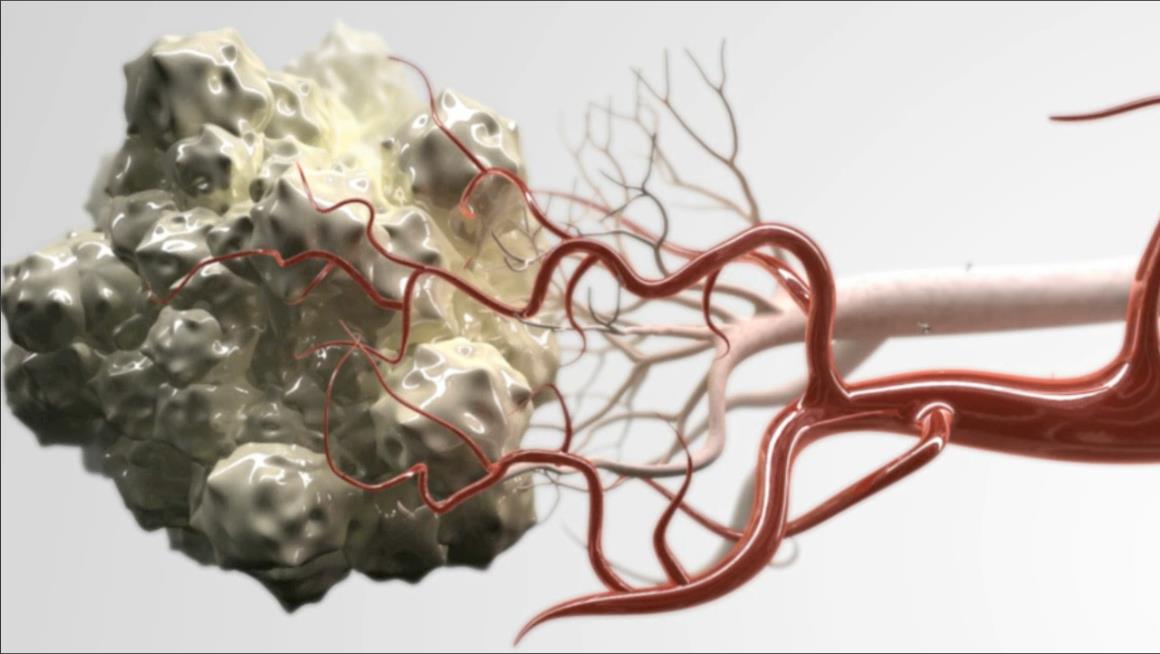 Aksitinib: İkinci nesil TKI Aksitinib, VEGFR-1, VEGFR-2 ve VEGFR-3 ün potent ve selektif bir tirozin