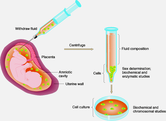 Prenatal tanıda Beta thalessemia,