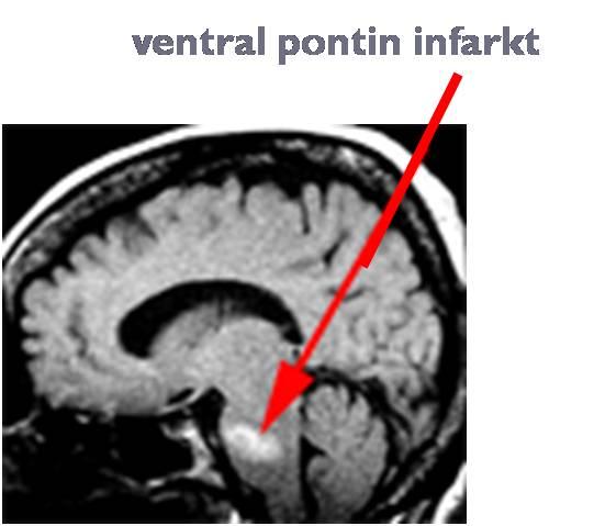 Locked-in Syndrome Bifasiyal pleji