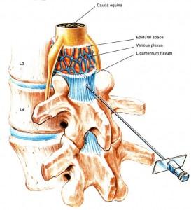 İNTERLAMİNER EPİDURAL STEROİD Hasta oturur pozisyonda yada ağrıyan taraf altta kalacak şekilde lateral