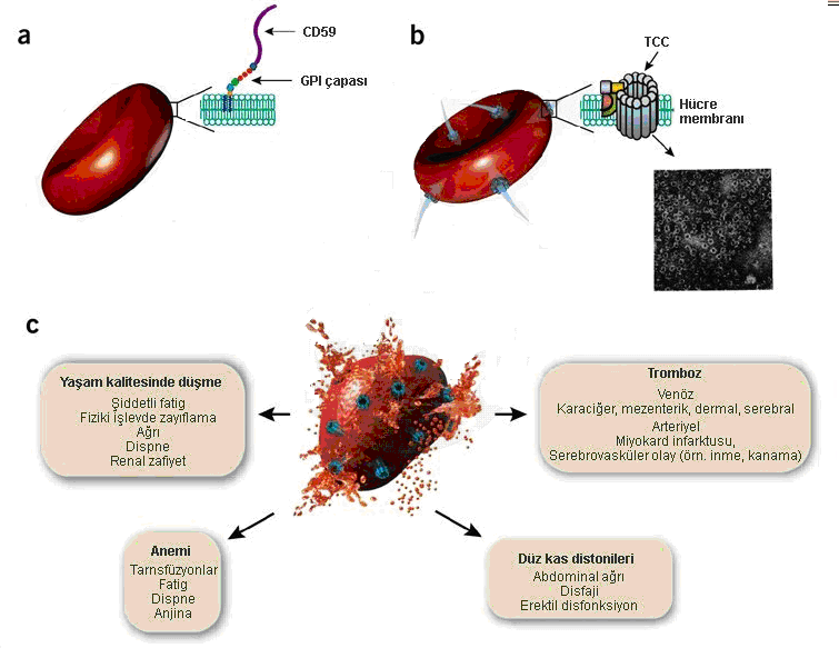 Paroksismal noktürnal hemoglobinüri tedavisi için ekulizumab ile kompleman C5 protein hedefine yönelik bloktur.