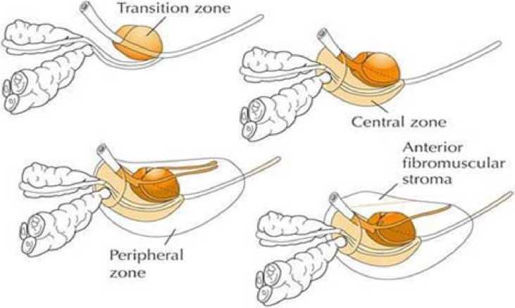 Hâlbuki benign prostat hipertrofisi transisyonel zonu tutar. Duktus ejakulatoriusu çevreleyen santral zon nadiren hastalıklardan etkilenir.