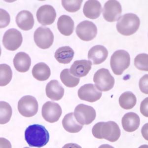 P. knowlesi hiperparazite mi 24 Sıtmanın klinik seyrini, Plasmodium'un türü yanında, kiģinin sıtmaya karģı doğal immünitesinin derecesi önemli ölçüde etkiler.
