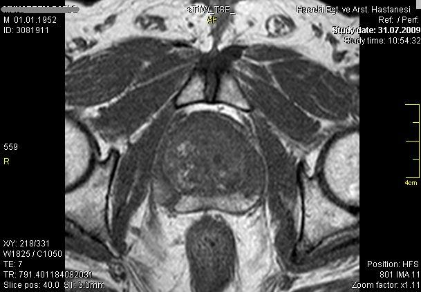 Şekil 19: T1A görüntüde (sağ) prostatın lobar anatomisi net seçilemezken, T2A görüntülerde (sol) santral ve periferik zonlar net olarak ayırt edilebilmektedir.