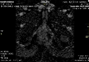 DAG ADC Şekil 21: Kemik metastaz T1A TSE, ve T2A TSE görüntülerde hipointens izlenirken T1A