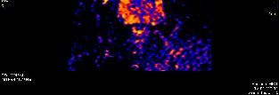ADC Renklendirilmiş ADC Şekil 22: Periferik zonda solda malign nodül. T1A görüntüde periferik zondaki nodül seçilemezken, santral zonda yoğun içerikli hiperintens bir kist görüldü.