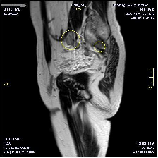 Aksiyel yağ baskılı T2A Aksiyel T1A Koronal T2A Sagittal T2A Şekil 23: Prostat MR öncesi pelvise yönelik T1A ve T2A görüntüler lenf nodu (büyük daire)ve kemik metastazların (küçük daire) görülmesini