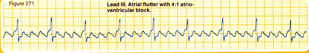 ATRİYAL FLATTER Özellikle DII, DIII, avf de görülen testere dişi şeklinde flatter dalgaları.