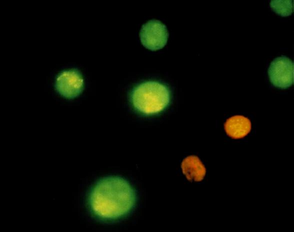 Şekil-3. Rapamisinin apoptotik etkisi (AO/EtBr). C EA N G A Şekil-4. Akridin Oranj Etidyum Bromid ile canlı (C), nekrotik (N), erken (EA) ve geç (GA) apoptotik hücreler (40x).