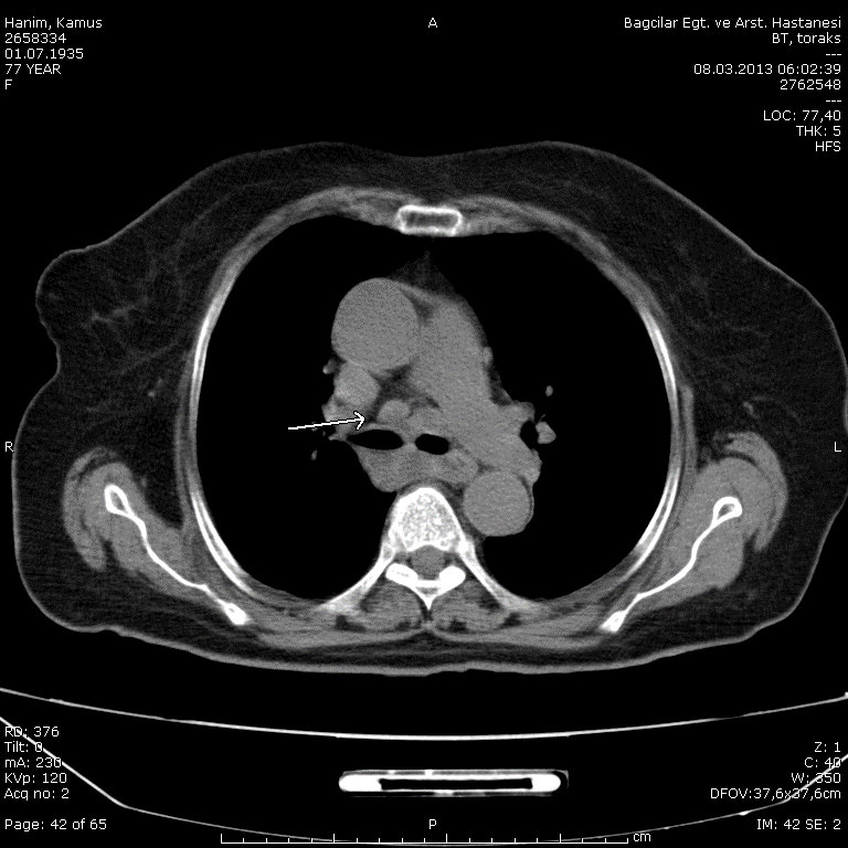Akciğer BT de; mediastinumda büyüğü subkarinal alanda 35mm ye ulaģan lenf nodları,