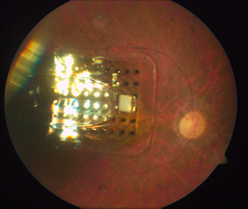 Kablosuz Algılarıcıların Güncel Kullanım Alanları Şekil 0.7 - Yapay Retina 2.