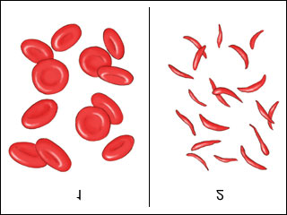 1. Orak hücre hastalõğõ nedir? Tõp dilinde orak hücre hastalõğõnõn birkaç ismi vardõr: sicklecell anemi, HbS hastalõğõ veya S/S hastalõğõ gibi.