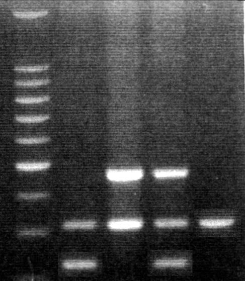 113 kişilik hasta grubunda GSTP1 Ala 114 /Ala 114 (wild type) genotipe sahip bireylerin sayısı 64 (% 74), Ala 114 /Val 114 (heterozigot) genotipe sahip bireylerin sayısı 11 (% 13) olarak saptanmıştır.