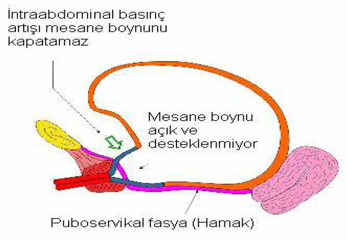 Pelvik taban yetmezliği fızyopatolojisinde nörolojik komponent de önemli bir yer tutar. Primer obstetrik hasar, pelvik taban kaslarını innerve eden sinirlere özellikle de pudental sinire olmaktadır.