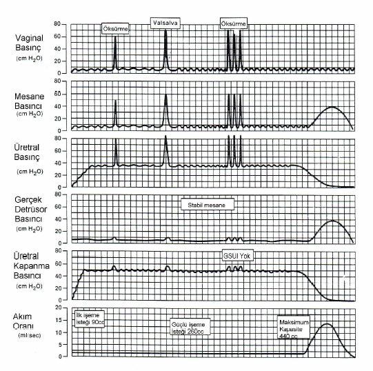 Üretral basınç profili klinik çalışmalarda yüksek hatalı pozitif ve hatalı negatif sonuçlar vermesi ve uygulanan tekniklerdeki farklılıklar nedeniyle normal