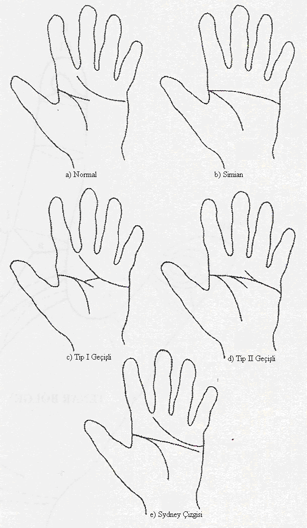 9 Şekil 1,5 Avuç içinde görülen bükülüm çizgileri: a ) Normal,