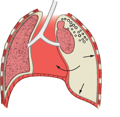 diyafragma intraplevral basınç artışı ile yerdeğiştiremezken, kollabe olan akciğer ve mediasten karşı tarafa doğru itilir.