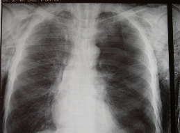 Đki yüz elli altı (%63.4) olguda başvuru şikayeti nefes darlığıydı. Diğer olgularda esas başvuru şikayetinin göğüs ağrısı olduğu belirlendi.