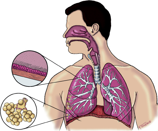 Akciğerlerin görünümü This is how the lungs normally look Slik ser lungene ut Burun ve yutak (farinks) Nose and throat Nese og svelg Ana solunum yolu (trakea) Wind pipe/trachea