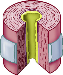 Astım ve nefes darlığı nedeniyle solunum yollarındaki değişim This is how your airways change with asthma and breathlessness Slik vil luftveiene dine endre seg med astma og tung pust Mukoza (balgam