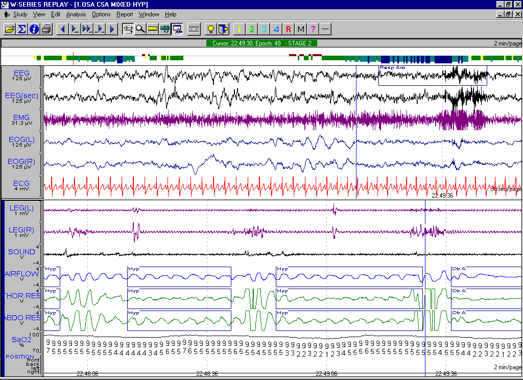 B. Hipopne için aşağıdaki tüm kriterlerin sağlanması gereklidir. 1. Hava akımında en az %50 azalma olmalı 2. Bu azalma en az 10 saniye sürmeli 3.