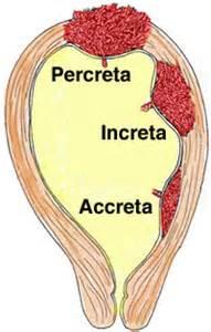 Plasenta myometriyumda ilerlemiştir. Plasenta serozaya / komşu organlara ulaşmıştır. %81.