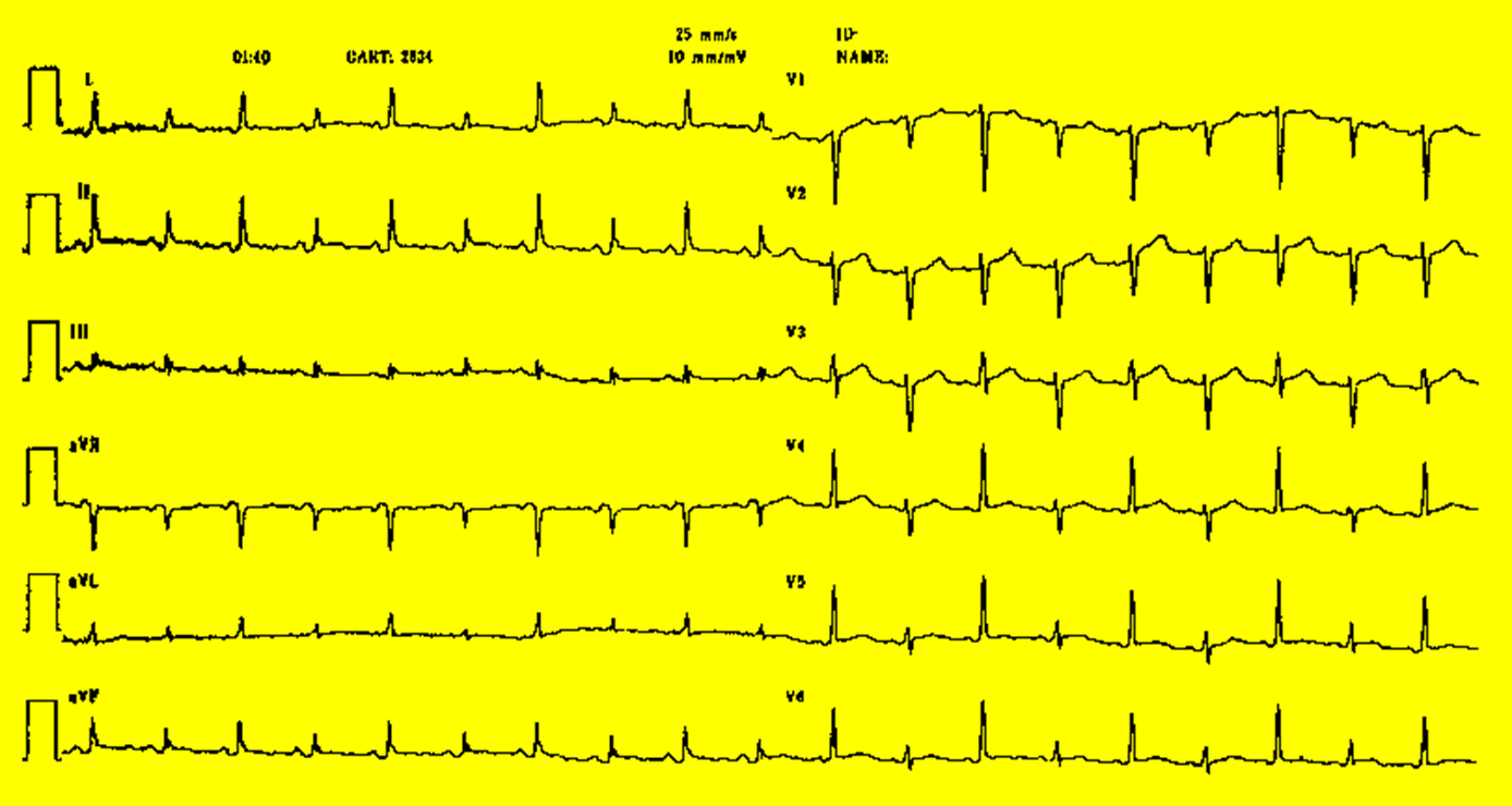 PERİKARD HASTALIKLARI Masif perikardiyal efüzyon Elektriksel Alternans P, QRS