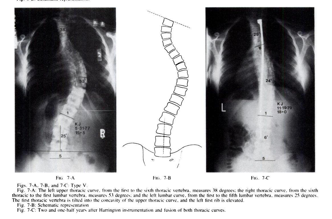 Tip V Double torasik eğriliklerdir. Tip V eğriliklerde üst torasik eğriliğin tanınması çok önemlidir. Klinik değerlendirmede bu hastalarda çift torasik hump deformitesi vardır.