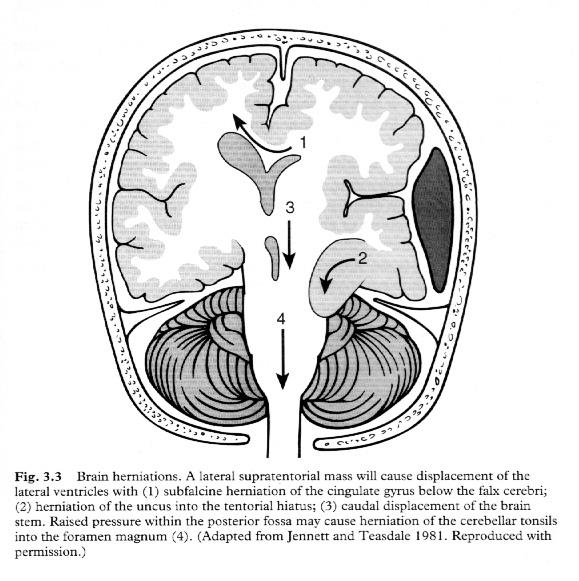 Herniasyon 1. Subfalcine 2.