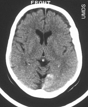 Subdural