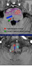 Trigeminal motor nükleus Esas trigeminal duyusal nükleus IV.ventrikülün dışyan bölümünün altında, pons dokusu içinde tegmentum pontis te yer alan nuc.motorius n.trigemini deki nöronlardır.