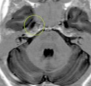 N.trigeminus u oluşturan kökler, ponsun ön yüzünde Küçük bir motor kök- Radix motoria (SVE lifleri olup, öniçyan kısımdan çıkarlar); Büyük bir duysal kök- Radix sensoria (GSA lifleri olup, dışyan