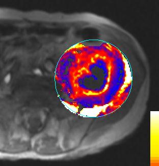 DCE-MRG DC+ MRG yanıt değerl için biomarker Konv KT, antianjiojenik ted, RT ve