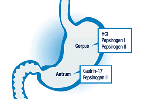 Atrofik Gastritte Tanı : GastroPanel Serum pepsinogen I düzeylerinde düģme Pepsinogen I/pepsinogen II oranında değiģiklik olması atrofik gastrit tanısında önemlidir.