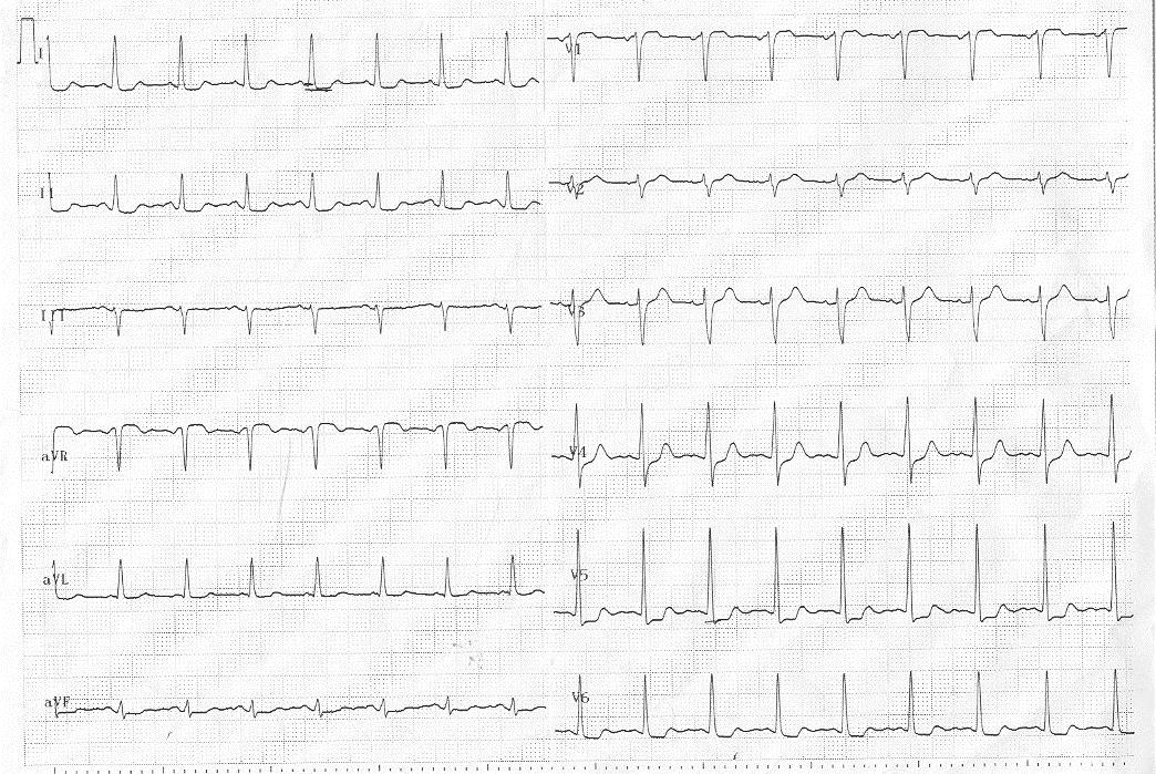 BOLUM 3 İzlemde EKG leri hep normal saptanan hastanın 6. saat kan değerleri: Myoglobin: 189 ng/ml (N:<75ng/mL) Troponin : 3.5 ng/ml (N:<0.