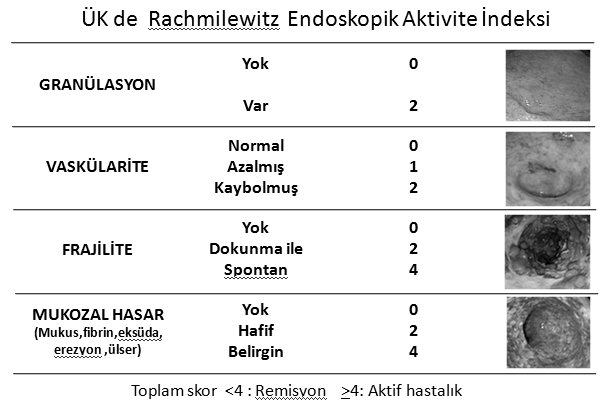 İlk başvuru sırasında Tablo-1 ÜK li hastaların %25 inde hafif, %65 inde orta ve %15 inde de şiddetli derecede hastalık bulunur.