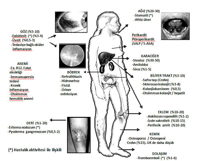 Şekil-2 İnflamatuvar barsak hastalığının uzun dönemde ortaya çıkabilecek ciddi bir komplikasyonu neoplazi gelişimidir.