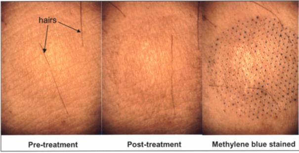 stratum corneum`da mikroskopik delikler oluşturmakta ve