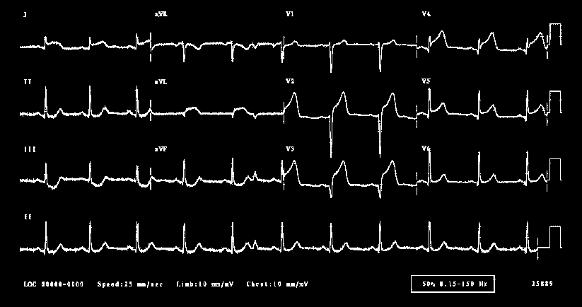 35..Göğüs ağrısı şikayeti olan hastanın EKG si aşağıdaki gibidir. En muhtemel tanı nedir.