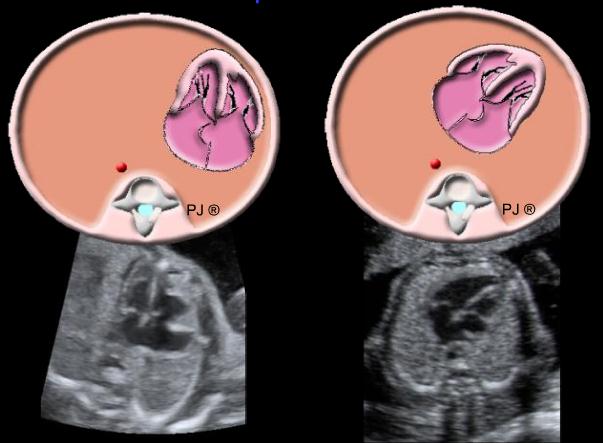 Mediastinal şift