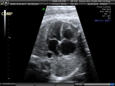 Atrial Septum Atrial