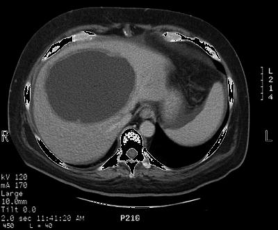 Amip apsesinde Ultrasonografi