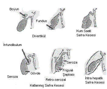 XXIII Duktus Sistukus Anomalileri: Bu anomaliler arasında duktusun uzun veya kısa olması, koledoğa paralel seyretmesi, koledoğun önünden yada arkasından geçerek koledoğa veya sağ hepatik duktusa