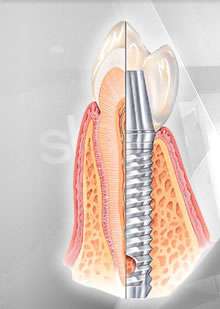 Doğal dişler çevresinde damarsal beslenme, alveolar komşu supraperiostal damarlardan ve periodontal ligamentteki damarlardan kaynaklanır.