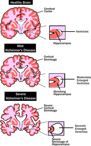 apoptozisin regülasyonu, Alzheimer hastalığına