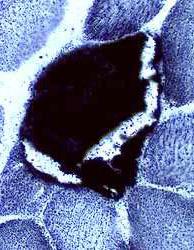 Mitokondriyal proliferasyon olan liflerde artmış SDH boyanması Anormal
